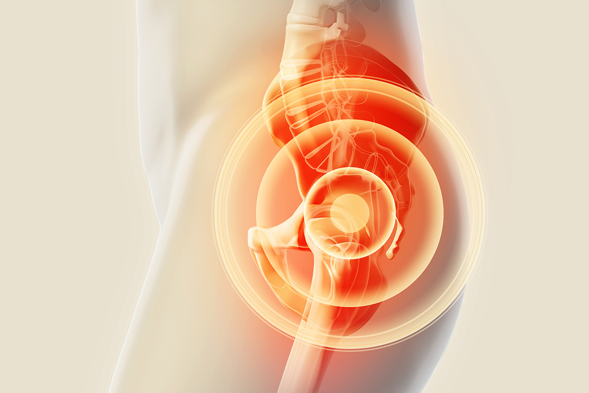 Hip Replacement Surgery in Kenya